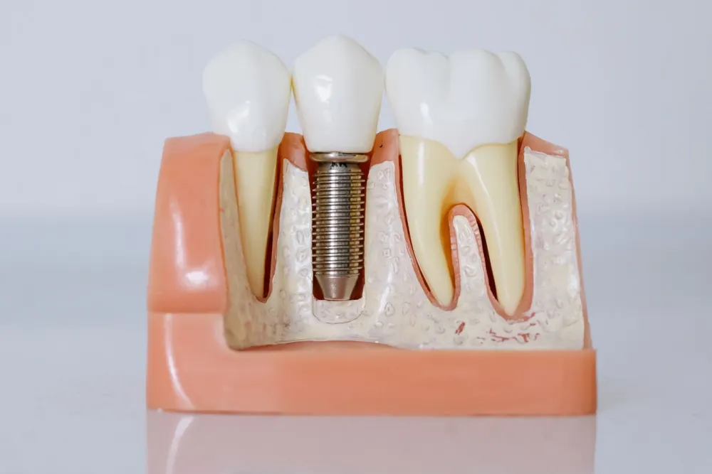 Preventing Cavities in Children with Fluoride